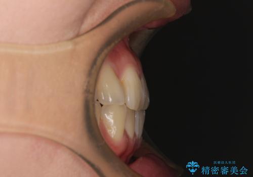 マウスピース矯正が煩わしい ワイヤー装置での非抜歯矯正の治療前