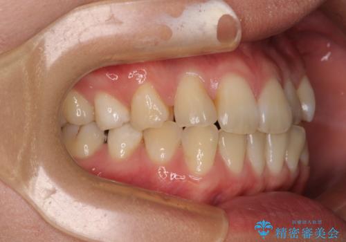 マウスピース矯正が煩わしい ワイヤー装置での非抜歯矯正の治療前