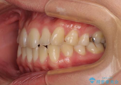 マウスピース矯正が煩わしい ワイヤー装置での非抜歯矯正の治療前