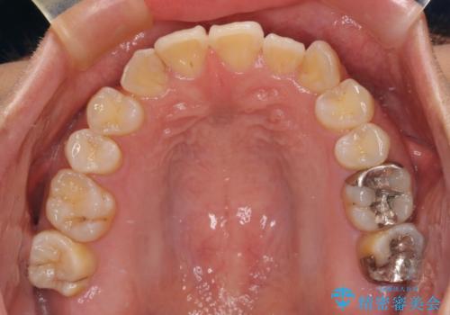 マウスピース矯正が煩わしい ワイヤー装置での非抜歯矯正の治療前