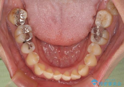 マウスピース矯正が煩わしい ワイヤー装置での非抜歯矯正の治療前