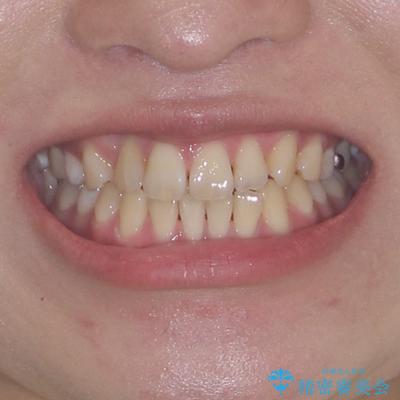 マウスピース矯正が煩わしい ワイヤー装置での非抜歯矯正の治療前(顔貌)
