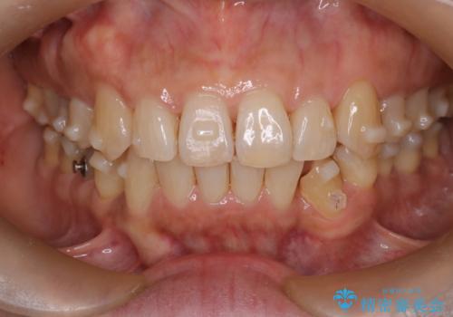 インビザラインで非抜歯矯正|ゴムかけで下顎犬歯の低位を改善し、噛み合わせも最適化の治療中