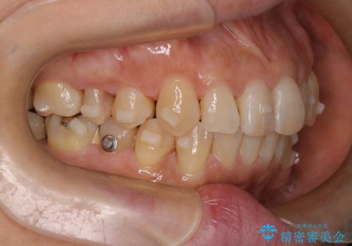 インビザラインで非抜歯矯正|ゴムかけで下顎犬歯の低位を改善し、噛み合わせも最適化の治療中