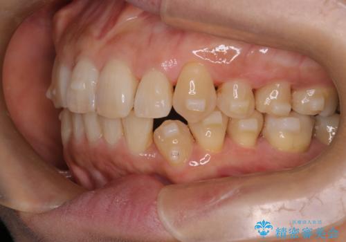 インビザラインで非抜歯矯正|ゴムかけで下顎犬歯の低位を改善し、噛み合わせも最適化の治療中