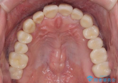 全部治療して見た目を良くしたい。の治療後