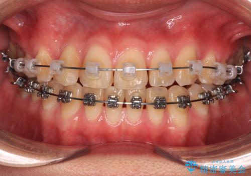 マウスピース矯正が煩わしい　ワイヤー装置での非抜歯矯正の治療中