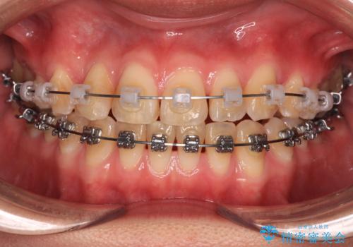 マウスピース矯正が煩わしい ワイヤー装置での非抜歯矯正の治療中
