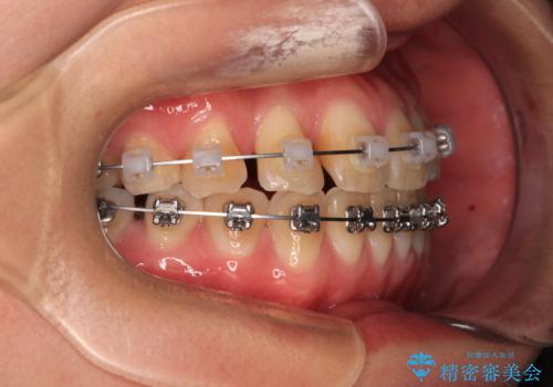 マウスピース矯正が煩わしい　ワイヤー装置での非抜歯矯正の治療中
