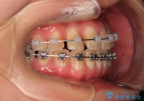 マウスピース矯正が煩わしい ワイヤー装置での非抜歯矯正の治療中
