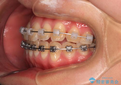マウスピース矯正が煩わしい ワイヤー装置での非抜歯矯正の治療中