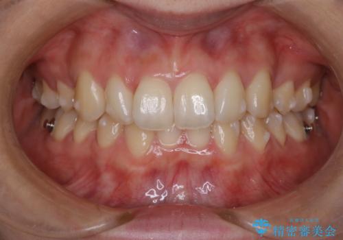抜歯矯正×インビザライン|上下のバランスを整え、美しい歯並びへの治療中