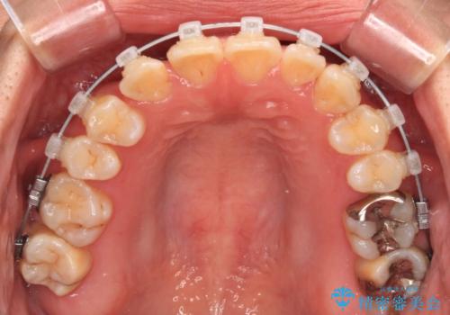 マウスピース矯正が煩わしい　ワイヤー装置での非抜歯矯正の治療中