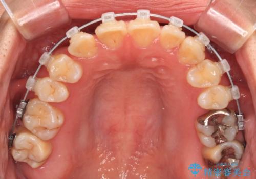 マウスピース矯正が煩わしい ワイヤー装置での非抜歯矯正の治療中