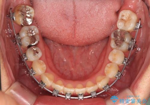 マウスピース矯正が煩わしい ワイヤー装置での非抜歯矯正の治療中