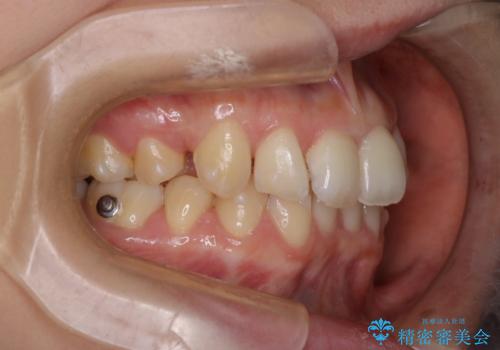 抜歯矯正×インビザライン|上下のバランスを整え、美しい歯並びへの治療中