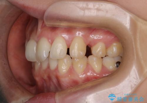 抜歯矯正×インビザライン|上下のバランスを整え、美しい歯並びへの治療中