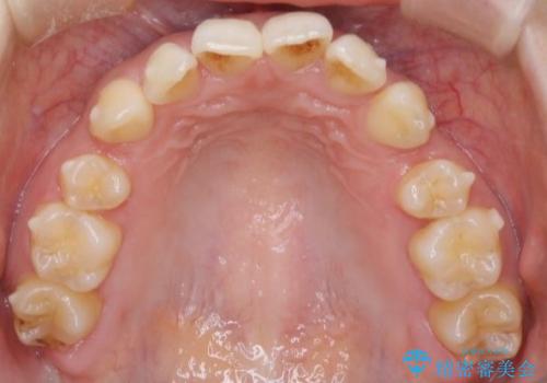 抜歯矯正×インビザライン|上下のバランスを整え、美しい歯並びへの治療中