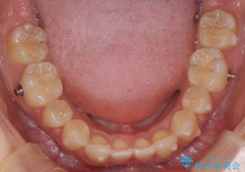 抜歯矯正×インビザライン|上下のバランスを整え、美しい歯並びへの治療中