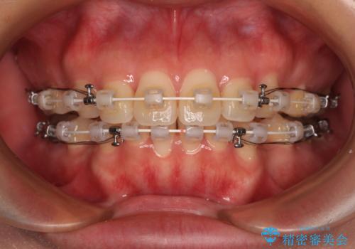 口元の突出感を改善したい。審美装置による抜歯矯正の治療中