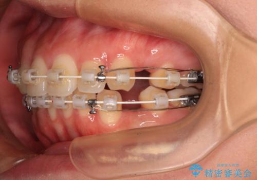 口元の突出感を改善したい。審美装置による抜歯矯正の治療中