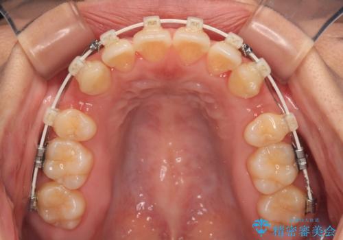 口元の突出感を改善したい。審美装置による抜歯矯正の治療中