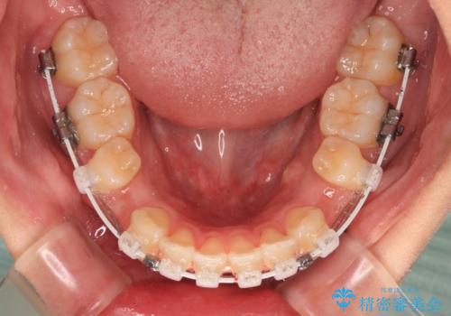 口元の突出感を改善したい。審美装置による抜歯矯正の治療中