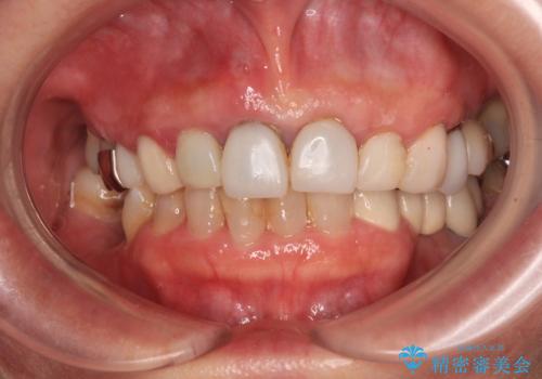 割れてしまった歯と深いむし歯 部分矯正と外科処置で安定したブリッジ治療の治療前