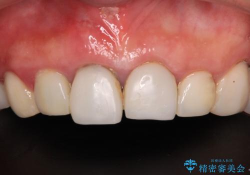 割れてしまった歯と深いむし歯 部分矯正と外科処置で安定したブリッジ治療の症例 治療前