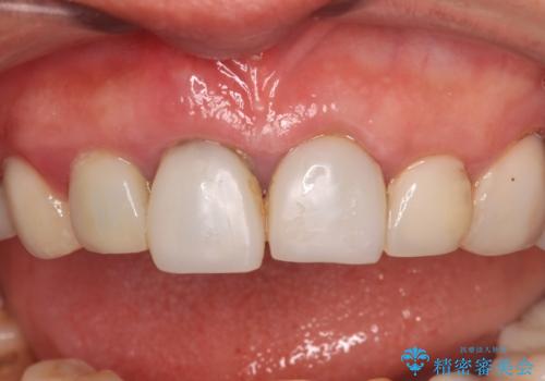 割れてしまった歯と深いむし歯 部分矯正と外科処置で安定したブリッジ治療の治療前