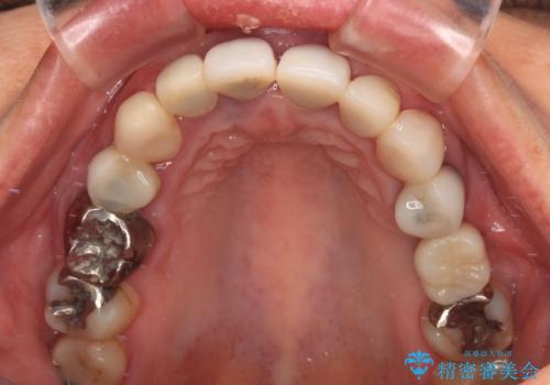 割れてしまった歯と深いむし歯 部分矯正と外科処置で安定したブリッジ治療の治療前