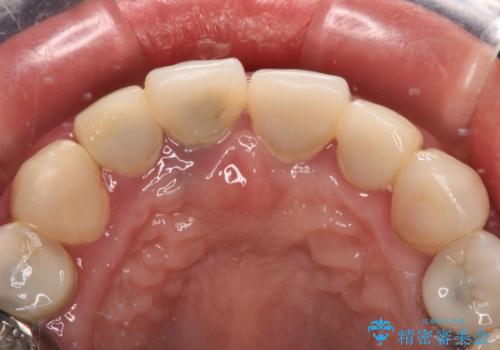 割れてしまった歯と深いむし歯 部分矯正と外科処置で安定したブリッジ治療の治療前