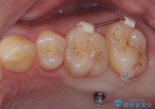 伸び出してきた上顎奥歯 部分矯正を用いた奥歯の補綴治療の治療中