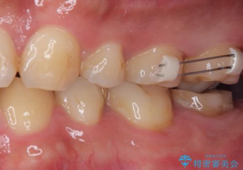 伸び出してきた上顎奥歯 部分矯正を用いた奥歯の補綴治療の治療中