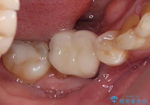 割れてしまった奥歯 インプラントによる補綴治療の症例 治療前