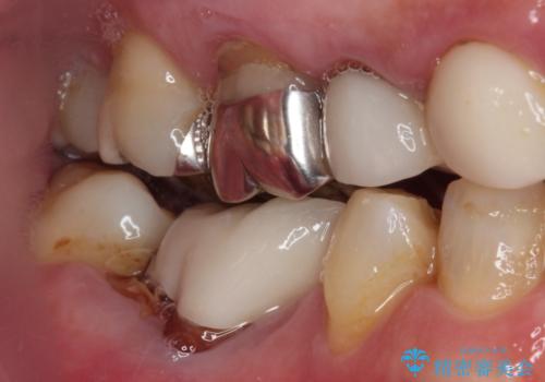 割れてしまった奥歯 インプラントによる補綴治療の治療前