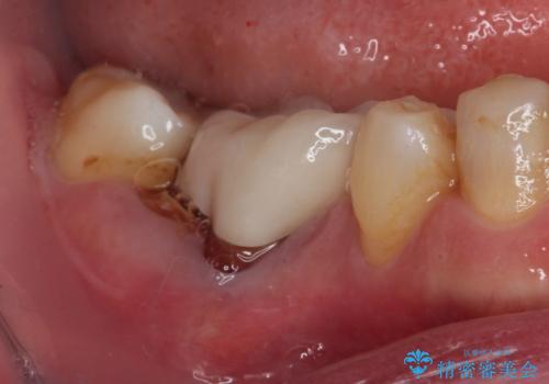 割れてしまった奥歯 インプラントによる補綴治療の治療前