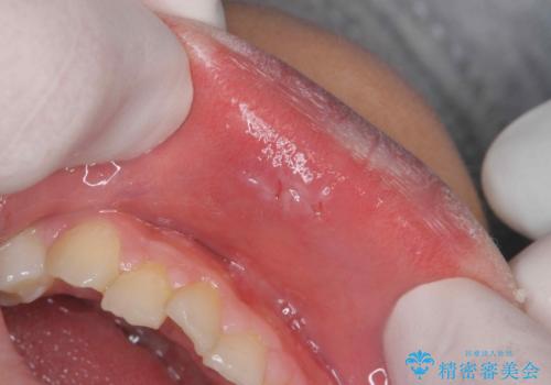 粘液嚢胞の切除の治療後