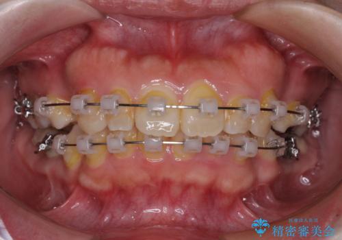 気になる出っ歯を治したい　ワイヤー装置の抜歯矯正でスッキリした横顔にの治療中