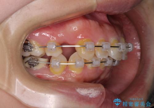 気になる出っ歯を治したい　ワイヤー装置の抜歯矯正でスッキリした横顔にの治療中