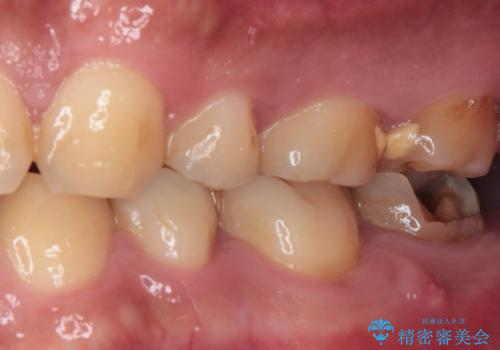 伸び出してきた上顎奥歯 部分矯正を用いた奥歯の補綴治療の治療前