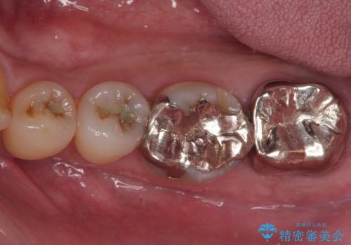 外れてしまった奥の銀歯 オールセラミッククラウンによる補綴治療の症例 治療前