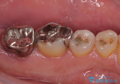 外れてしまった奥の銀歯 オールセラミッククラウンによる補綴治療の治療前