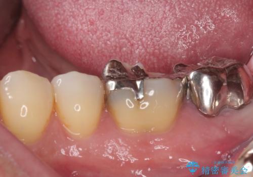 外れてしまった奥の銀歯 オールセラミッククラウンによる補綴治療の治療前