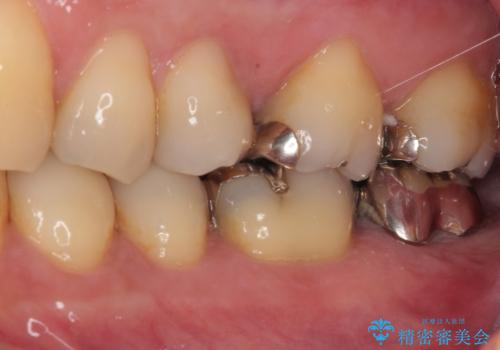 外れてしまった奥の銀歯 オールセラミッククラウンによる補綴治療の治療前