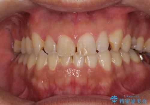 放置していたむし歯 抜歯即時埋入インプラントで負担を軽減の治療前
