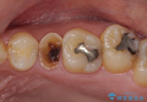 放置していたむし歯　抜歯即時埋入インプラントで負担を軽減の治療前