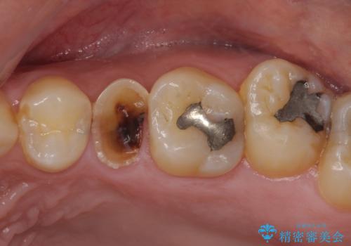 放置していたむし歯 抜歯即時埋入インプラントで負担を軽減の治療前