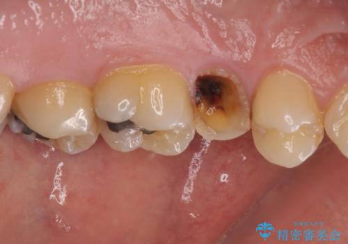 放置していたむし歯　抜歯即時埋入インプラントで負担を軽減の治療前