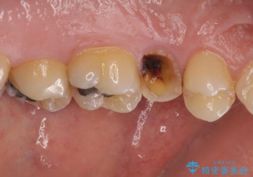 放置していたむし歯 抜歯即時埋入インプラントで負担を軽減の治療前